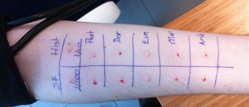 alerji testi nasıl yapılır 1232